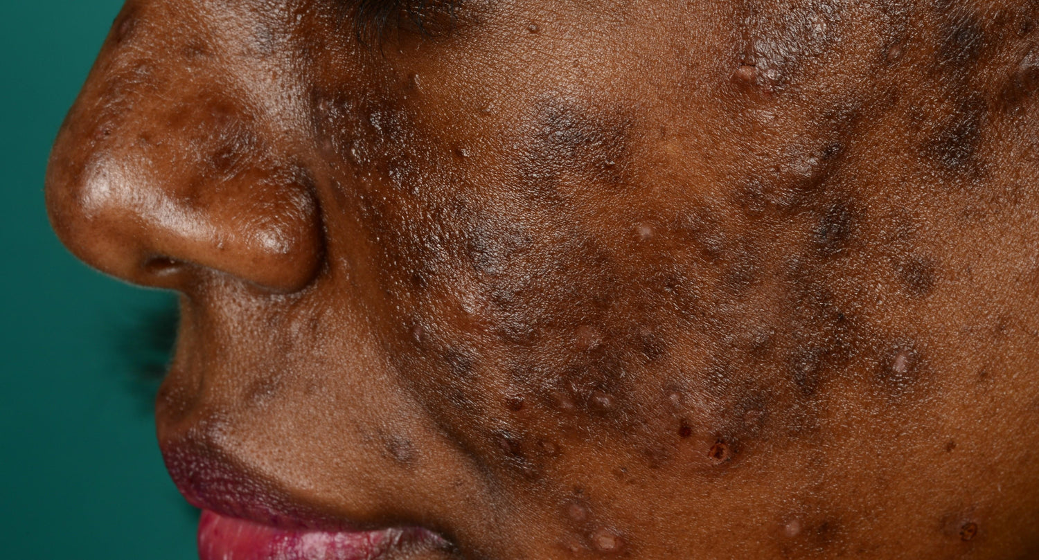 Acne & Breakouts
