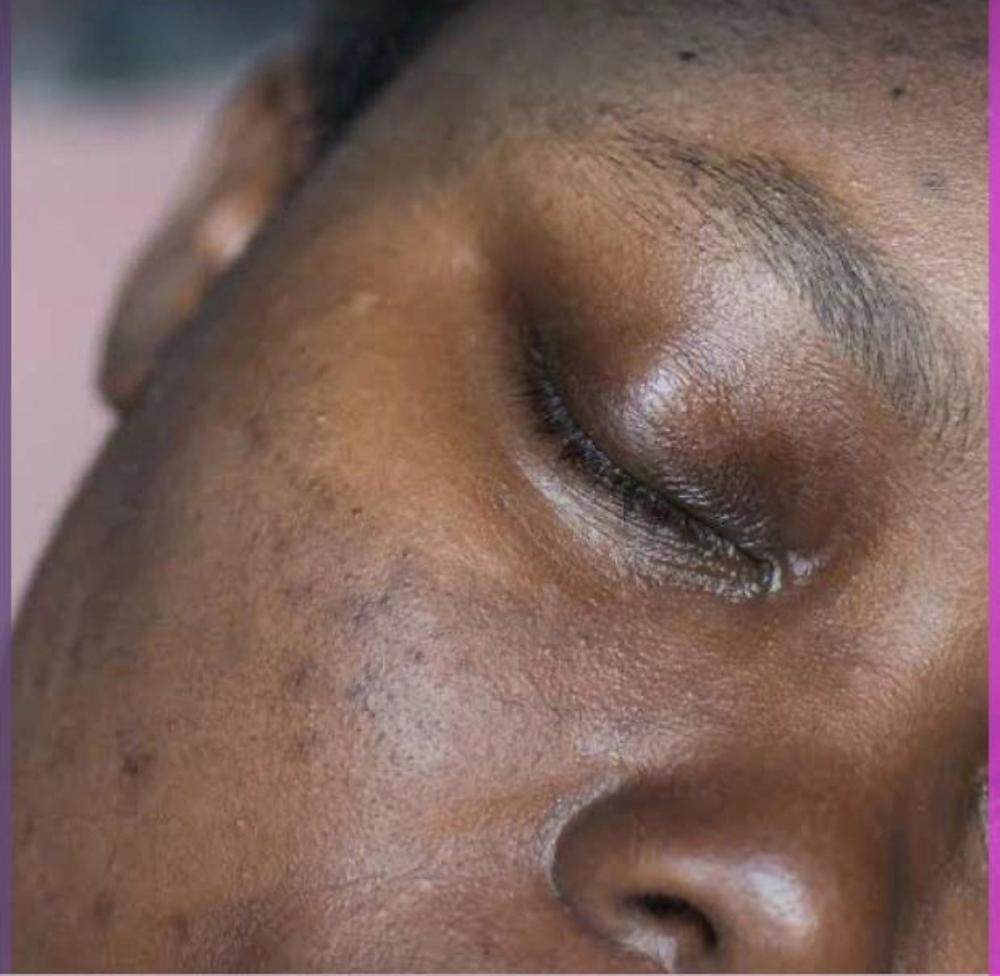 Dark Marks & Hyperpigmentation