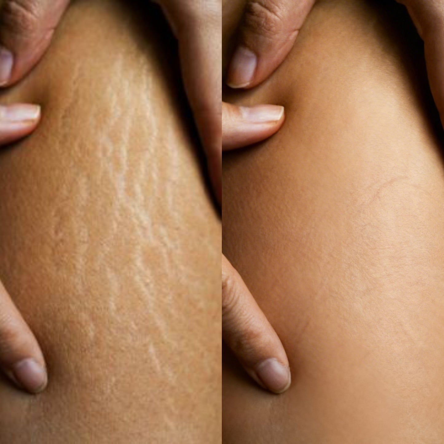 Stretch Mark Oil